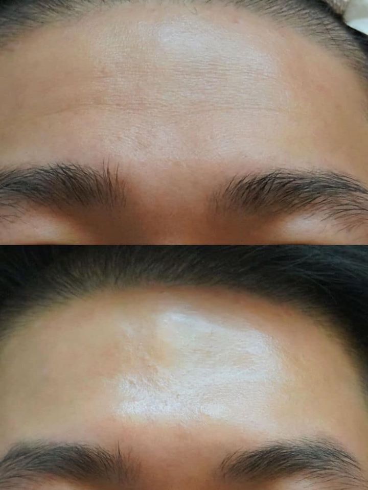 岡山肉毒 岡山波拉提針 岡山美形針 少女針 減重 岡山電波拉皮 艾麗美服務項目